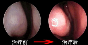 过敏性鼻炎治疗前后对比