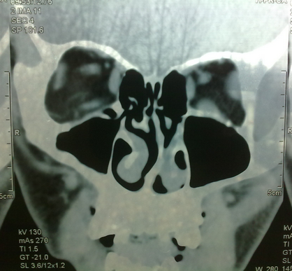 鼻炎CT图片