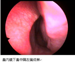 鼻中隔偏曲内窥镜图片