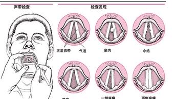 声带息肉的常见症状有哪些_南京耳鼻喉科医院排名【与医生通话询问
