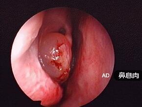 鼻息肉病.jpg