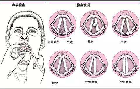 声带息肉是因为吸烟引起的?多吃点绿豆