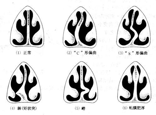 鼻中隔偏曲的治疗法