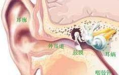 鼓膜炎的症状