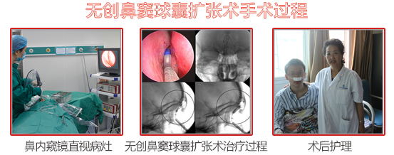 无创鼻窦球囊扩张术手术过程
